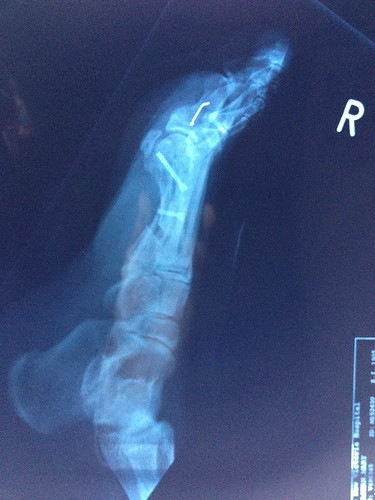 Bunion x-ray after - side view