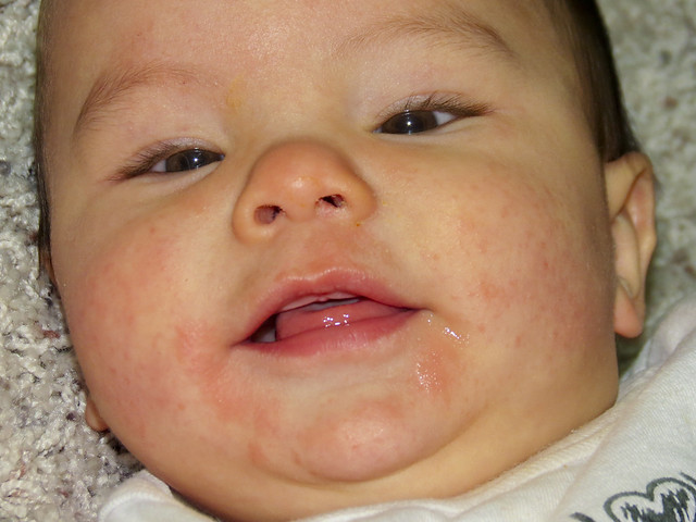 How To Treat A Rash Around My Baby's Mouth - Circle of Moms