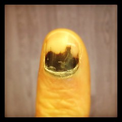 My finger nail bruise looks like a picture of a city at dusk.