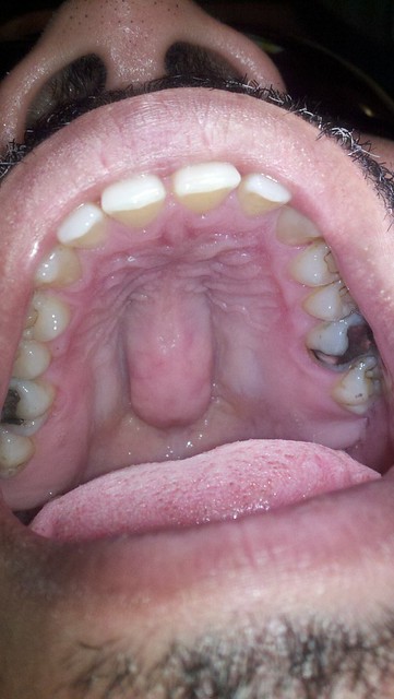 tori mouth bones
