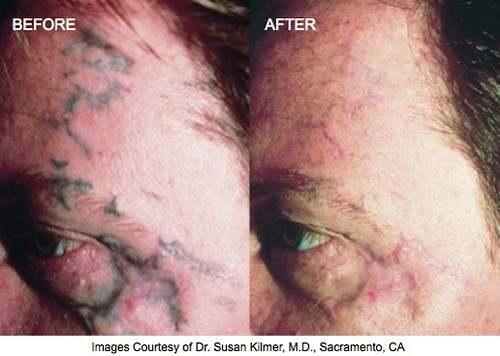 Dr. Darm Tatoo Removal Before and After_03
