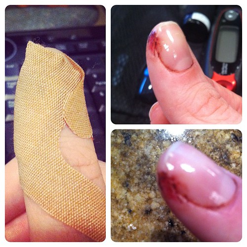 My chopped up thumb. 20% missing was a blood loss exaggeration. More like 5%.