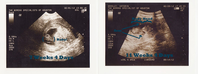ultrasounds 7 and 11 detailed