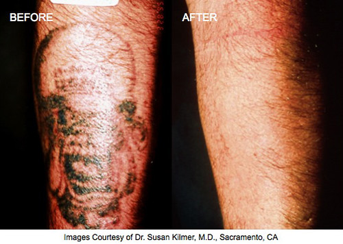 Dr. Darm Tatoo Removal Before and After_05