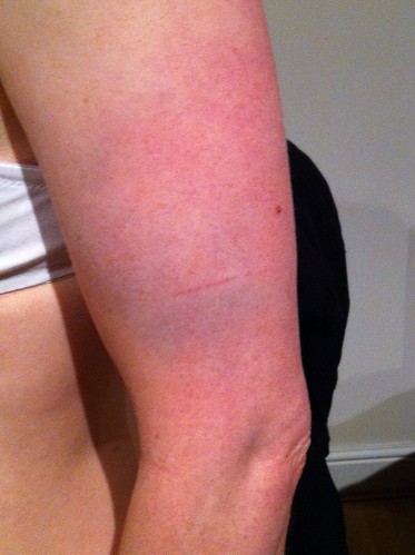Bruise - slam plus 2 hours