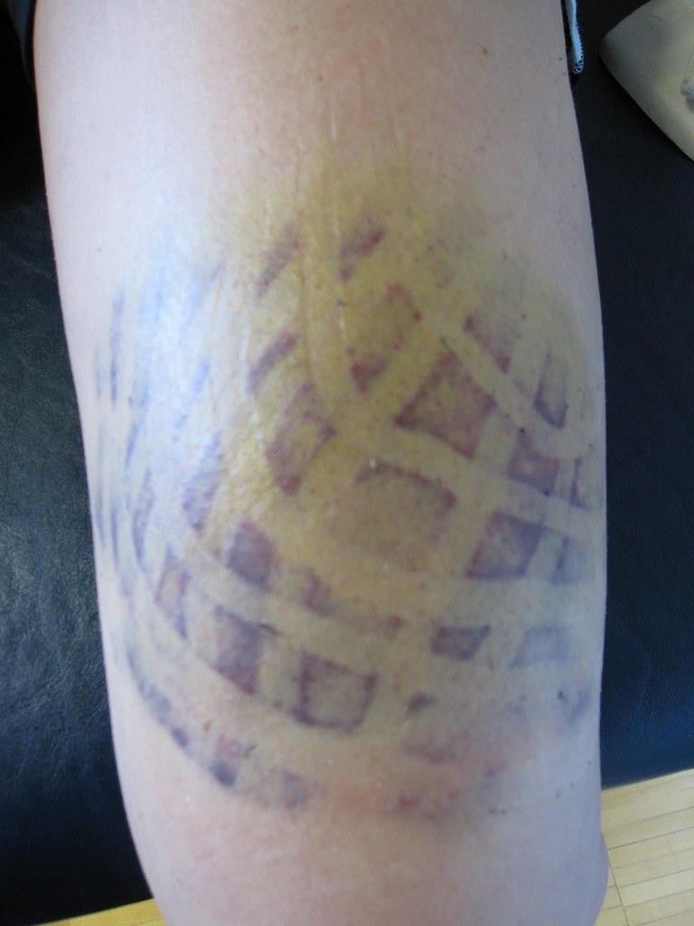 results after kinesiotape with quadriceps bruise