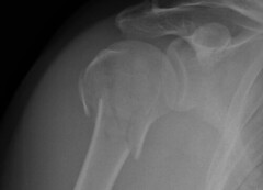 X-ray showing broken bone