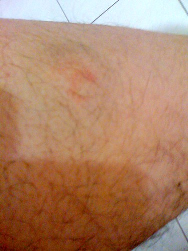 Paintball wound