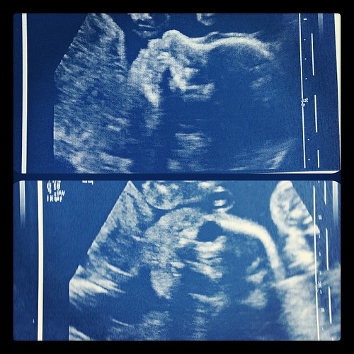 Baby girl on top, baby boy on the bottom. 25 weeks. #pregnancy #twins