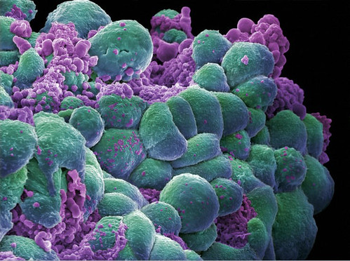 B0006421 Breast cancer cells