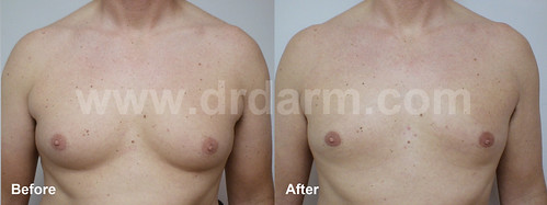 Dr. Darm LipoLift Before and After DSC02708