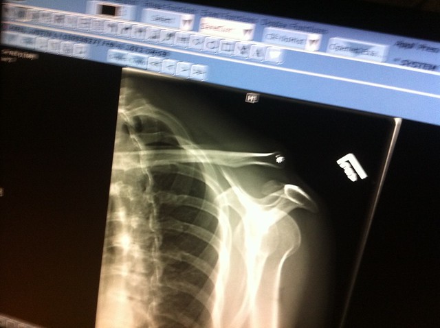 X-ray of left shoulder