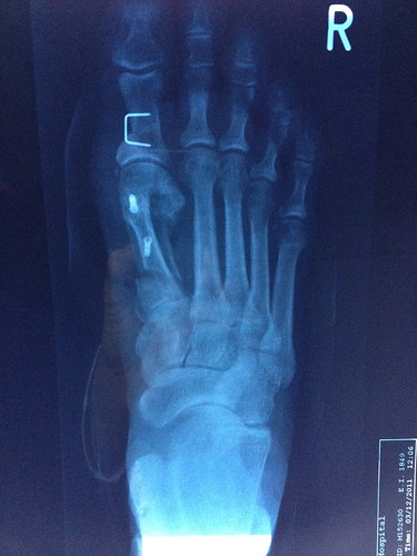 Bunion x-ray after - top view