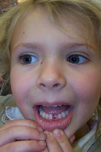 Q5 missing tooth