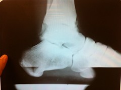x-ray of my ankle