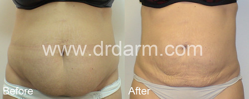 Dr. Darm Lipolift Before and After 2012 1