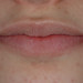 selamento labial passivo - durante o tratamento e avanço mandibular.
