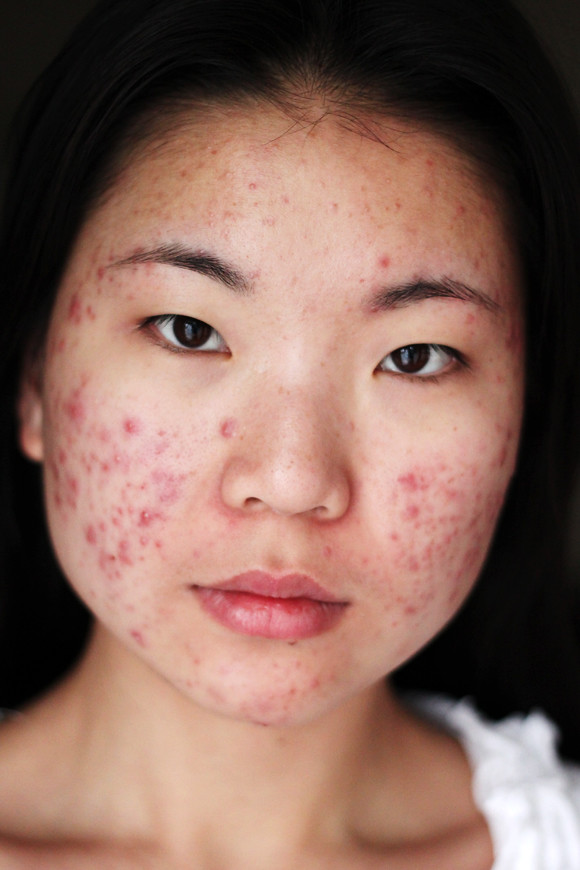girls with acne porn picture