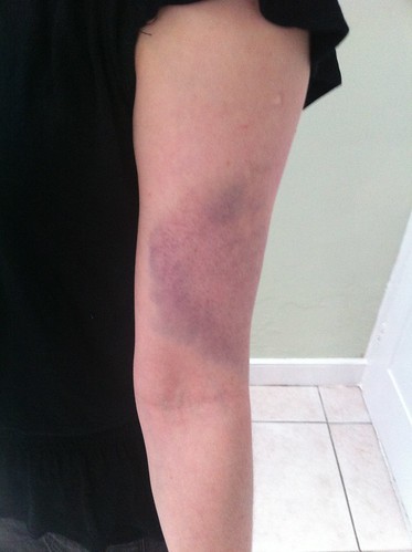 Bruise, getting nice purple now