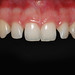 diastêmas dentários - superior
