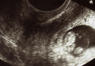 8-week Ultrasound