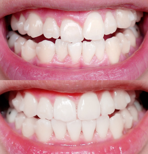 typicalben  invisalign teeth  updates