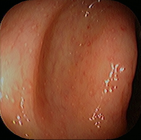 Apthous Ulcers of the Colon
