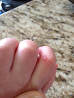 Hand-Foot-and-Mouth Disease Blisters