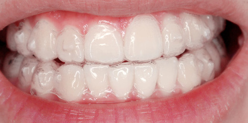 typicalben teeth 15th set of invisalign