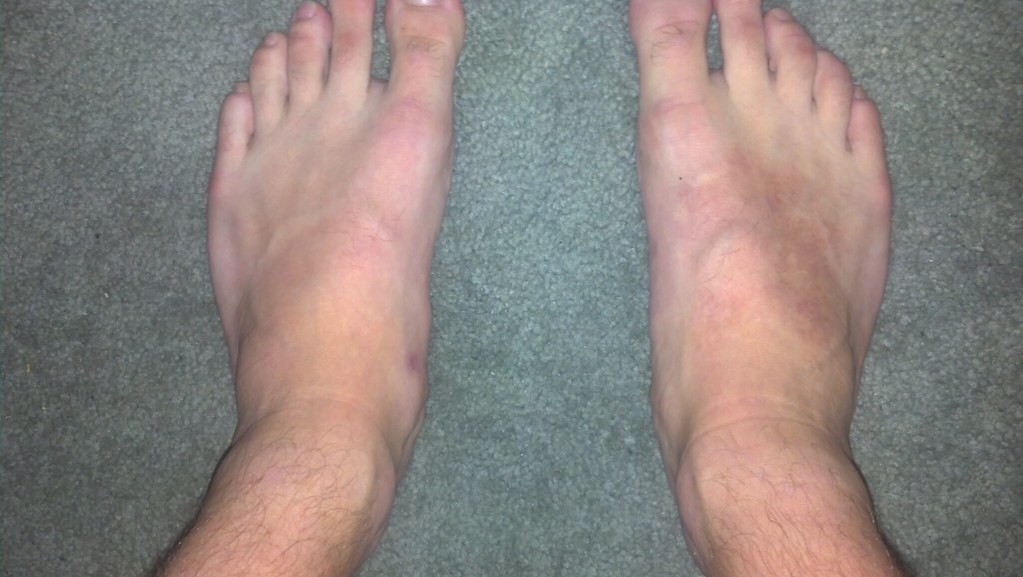 Discoloration On Top Of Foot No Other Symptoms Foot Health Forum