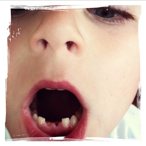 Another tooth bites the dust. That's two in a month. Woah!