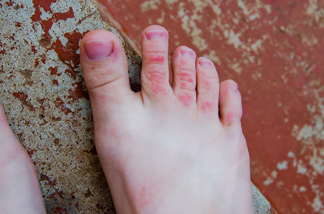 Itchy, red, swollen foot.feet - Dermatology - MedHelp