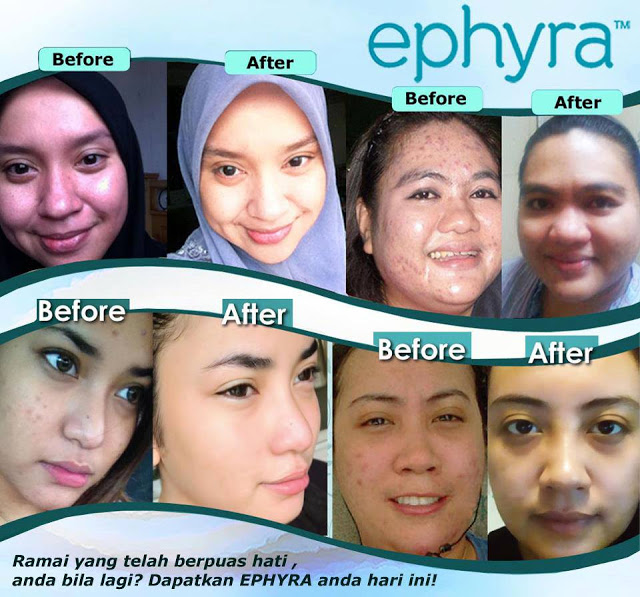 before and after of ephyra