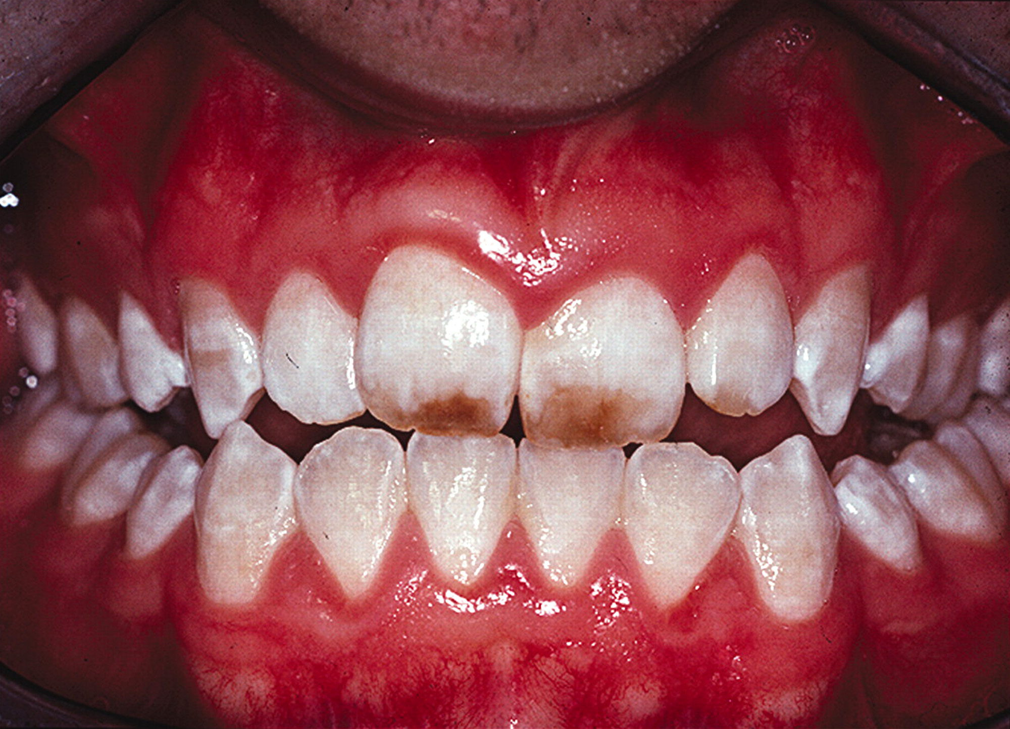 दांतों में फ्लोरोसिस