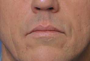 After Injection of Restylane in New Jersey