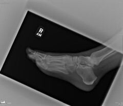 Foot X-ray, April 10, 2014