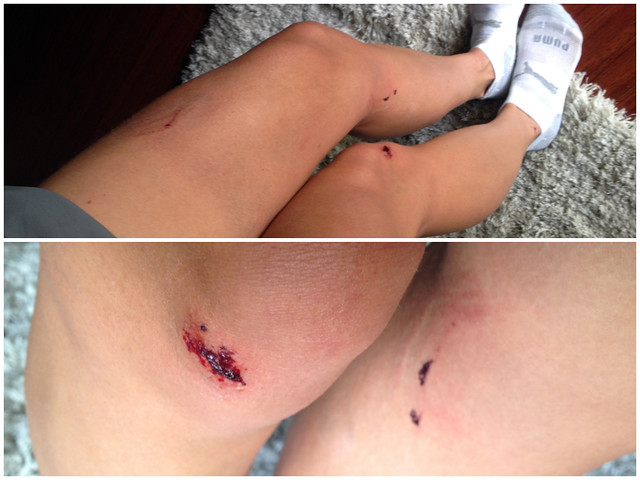 bike crash bruises
