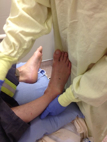 Severe Ankle Dislocation