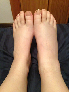 Swollen foot, day 2