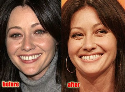 Shannen Doherty Plastic Surgery Before and After Botox Injections, Nose Job and Facelift