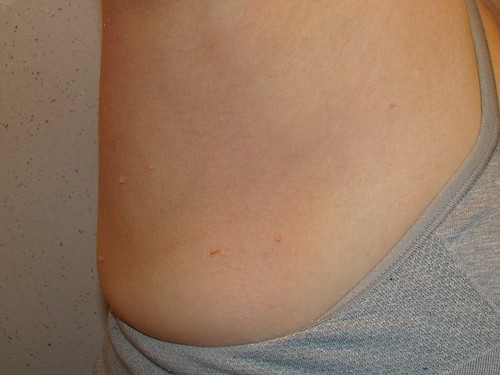 Dr. Joel Schlessinger patient with skin tags