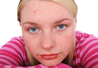 Teenage Girl With Acne