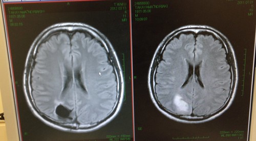 脳腫瘍摘出手術前後のMRI画像（グリオーマ グレード3）