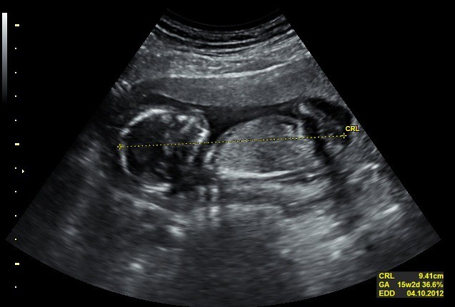 15 weeks Baby in 2D Ultrasound | 15 weeks baby image in 2D u… | Flickr