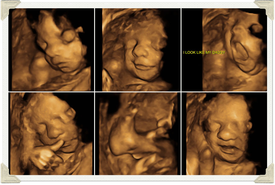 3d4d Ultrasound Photos. 