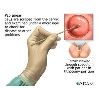 cervical-cancer-pap-test-752185