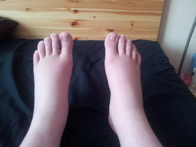 swollen-feet-flickr-photo-sharing