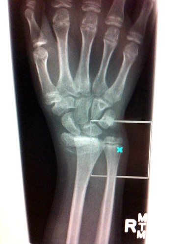 broken accident snowboard bones bone wrist fracture radius ulna