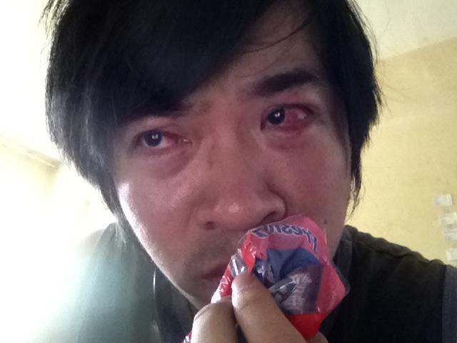 Steven Lim with injured eyes (image via Steven Lim's Facebook page)