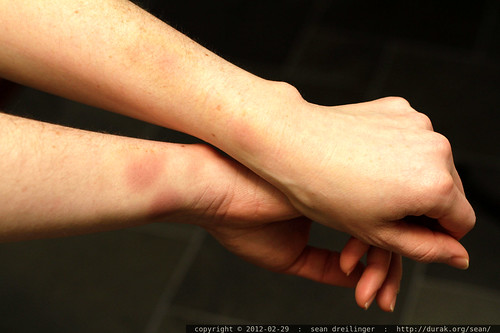 bruised wrists from last night's karate exam    MG 9652
